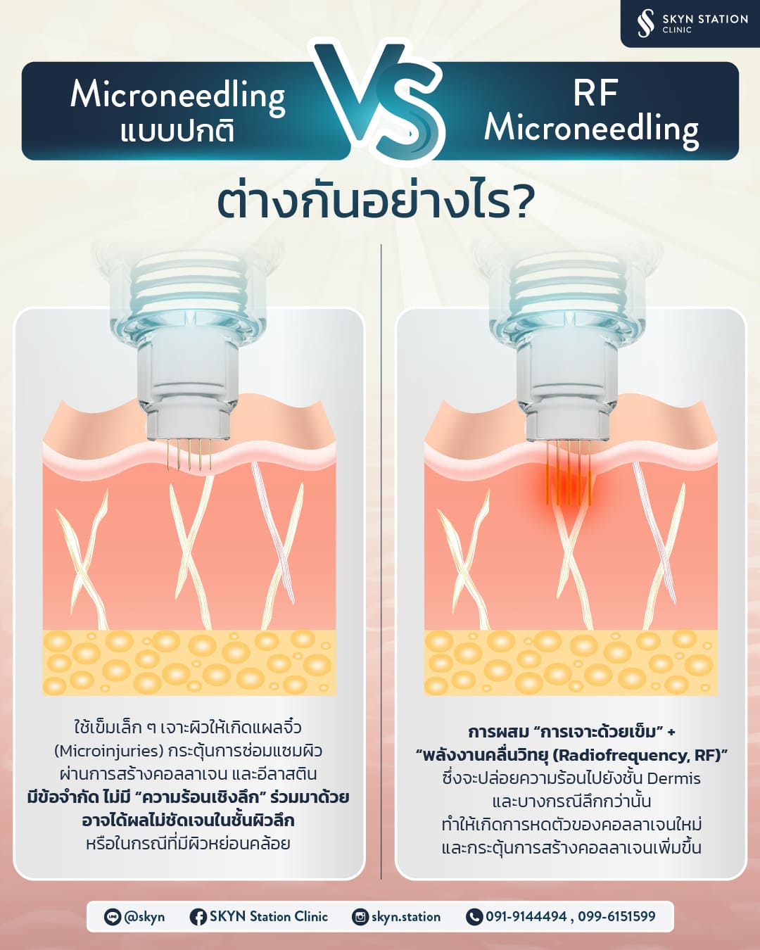 AW-SKYN-Microneedling-vs-RF-01