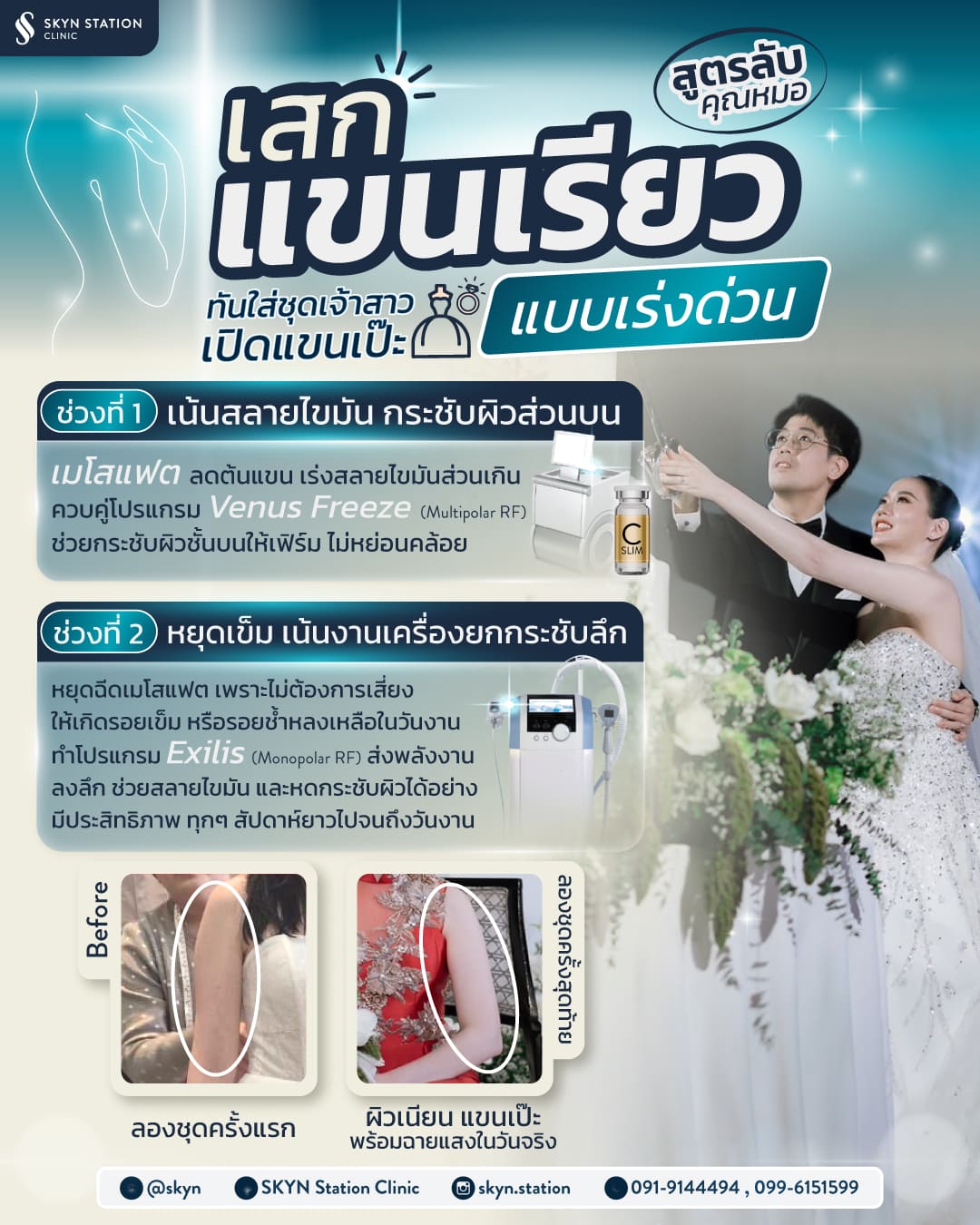 AW-SKYN-Slim-Arms-for-Bride-Content1-TH