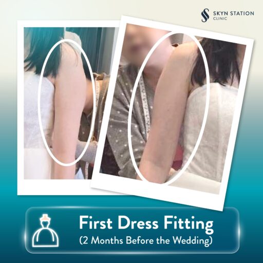 AW-SKYN-Slim-Arms-for-Bride-Content2-EN