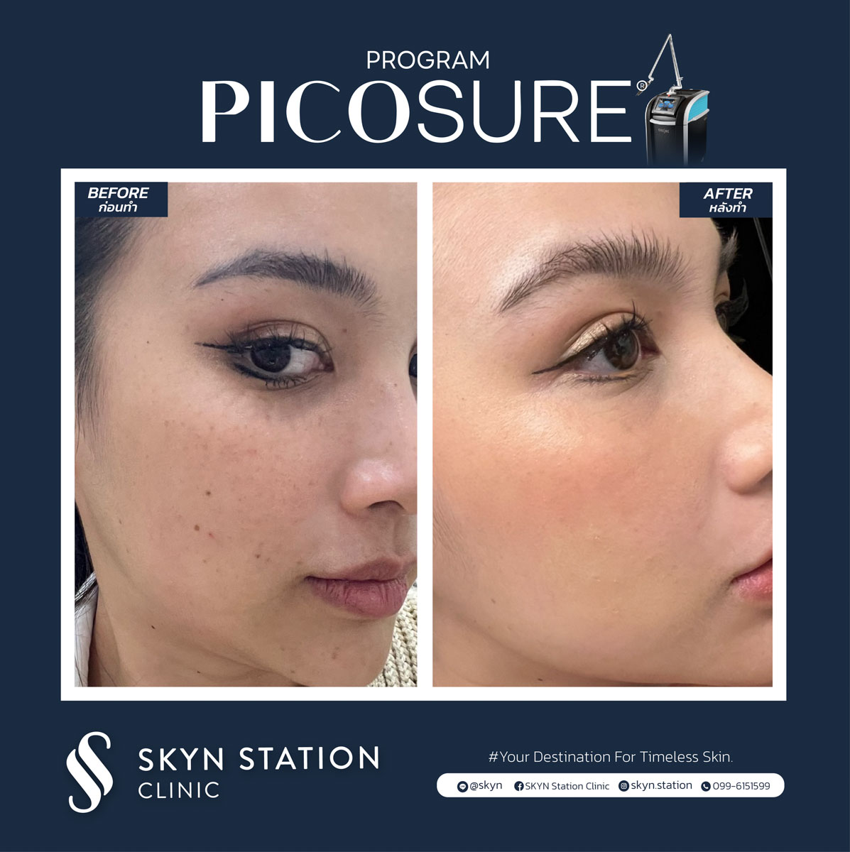 REVIEW Picosure