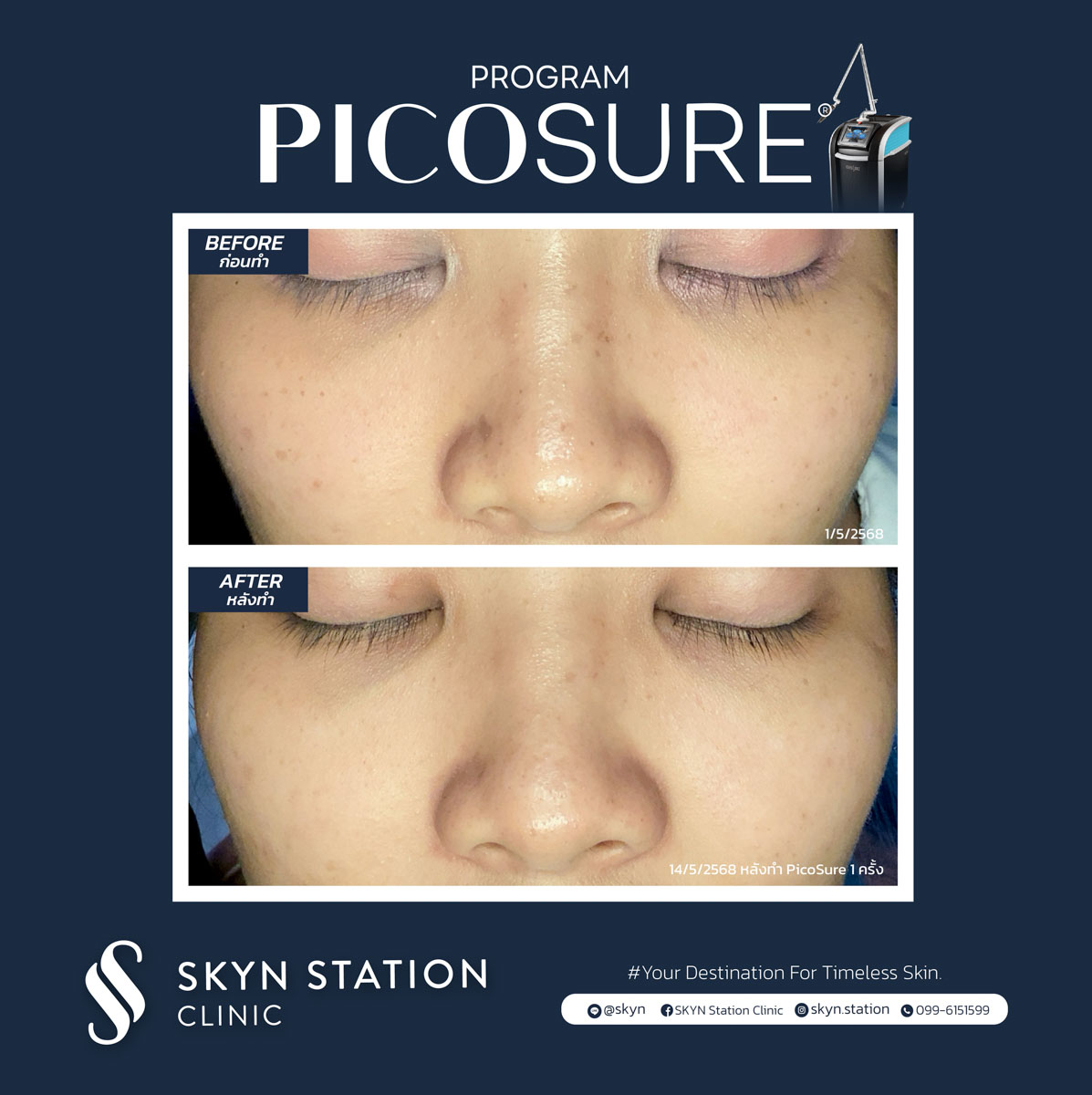 REVIEW Picosure