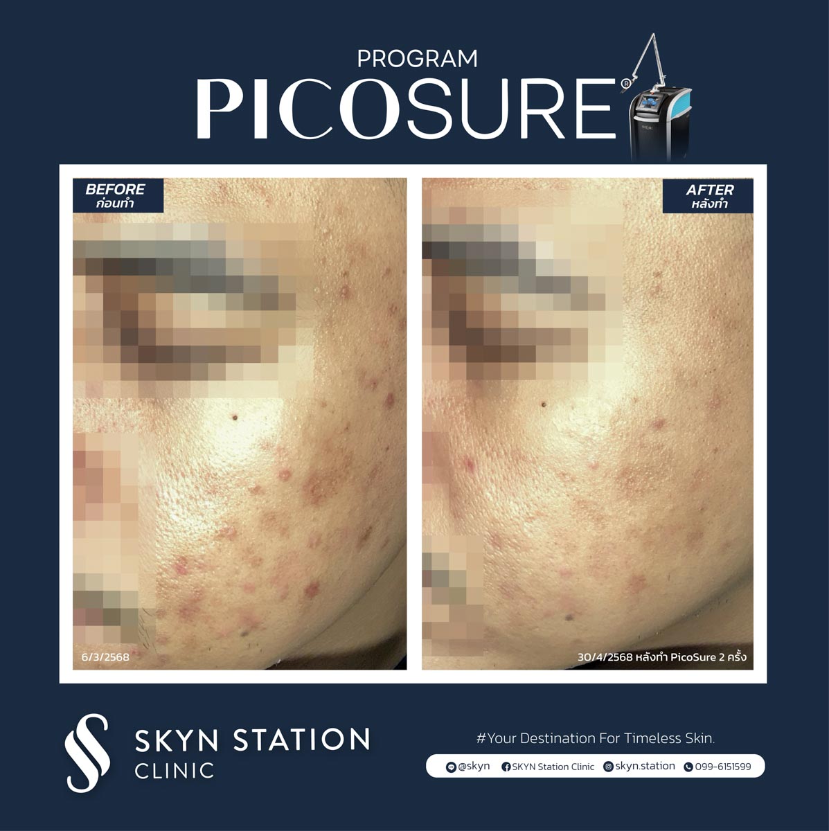 REVIEW Picosure