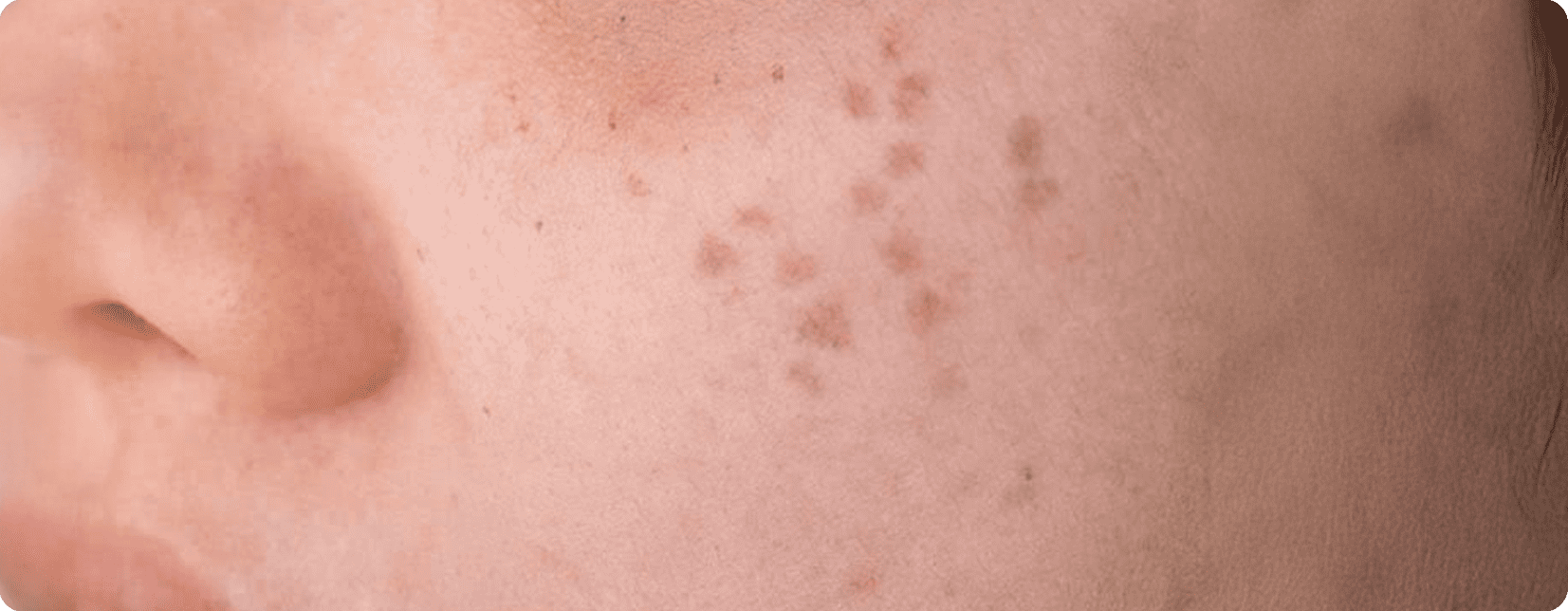 aw-banner-Hori’s-Nevus+